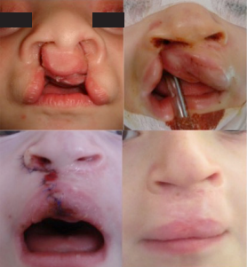 Patient with Familial Nonsyndromic Cleft Lip and Palate with Unaffected Parents